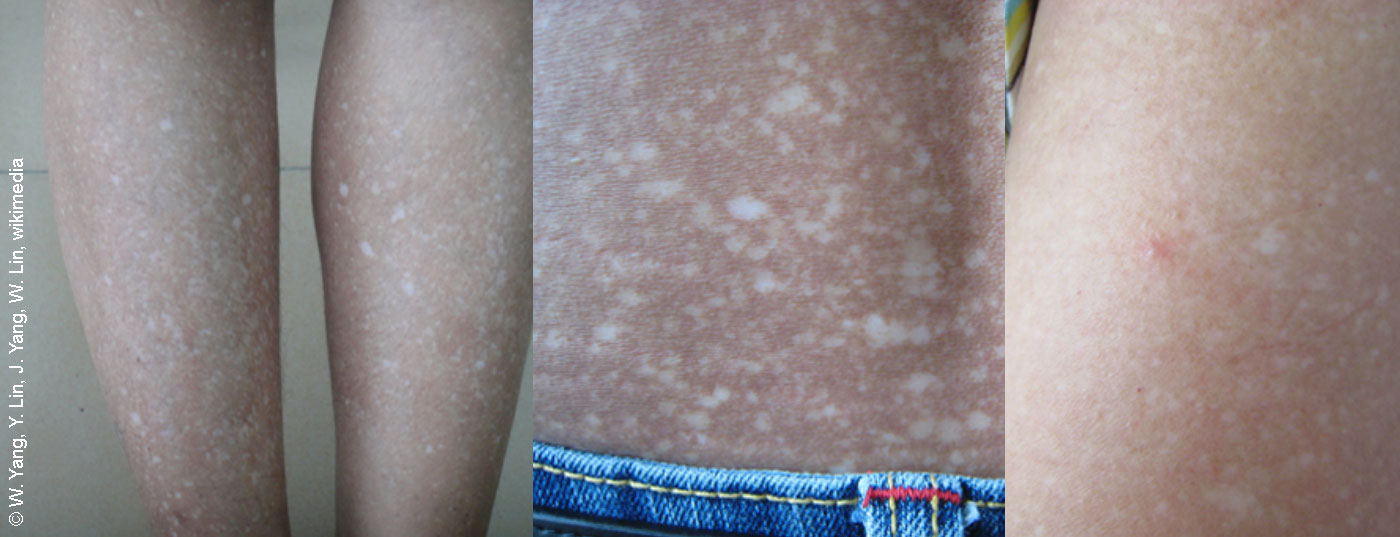 amyloidosis_cutis_dyschromica