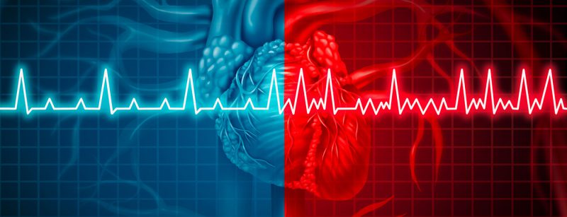 ekg_vorhofflimmern_istock-947331372