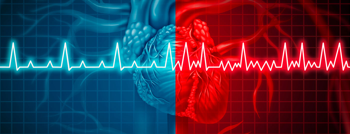 ekg_vorhofflimmern_istock-947331372