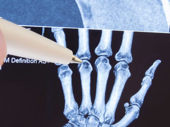 gelenk_hand_roentgen_istock-877181312