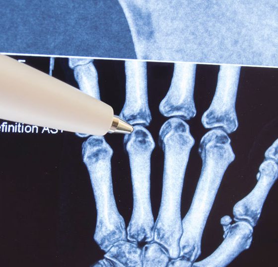 gelenk_hand_roentgen_istock-877181312