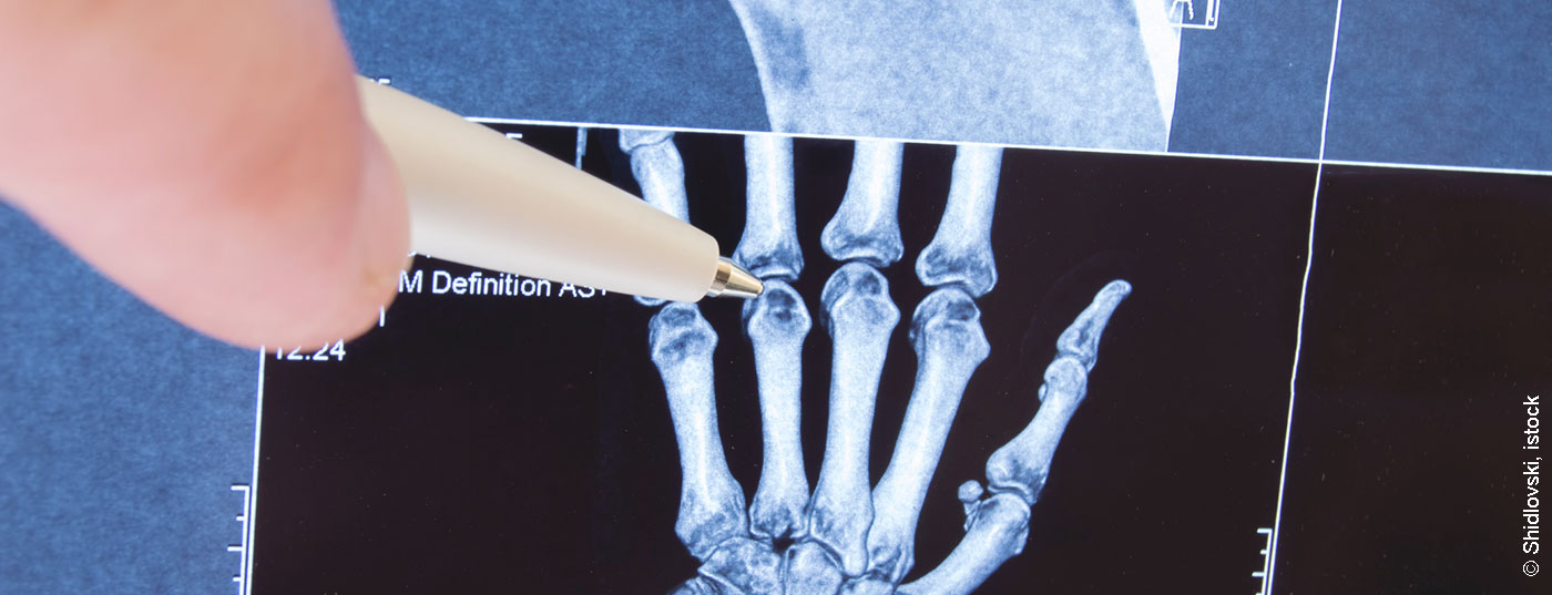 gelenk_hand_roentgen_istock-877181312