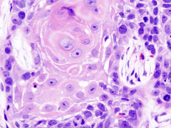 oral_cancer_1_squamous_cell_carcinoma_histopathology