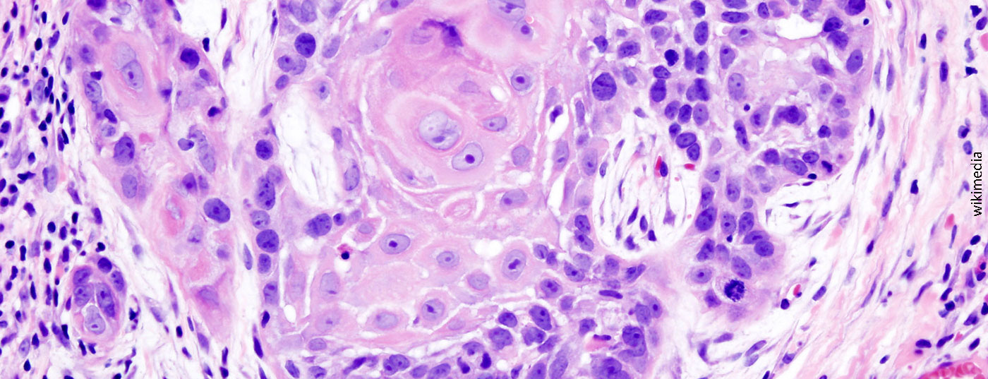 oral_cancer_1_squamous_cell_carcinoma_histopathology