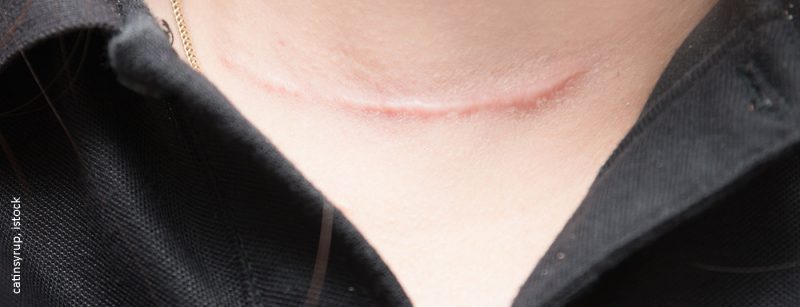schilddruese_narbe_istock-930740678