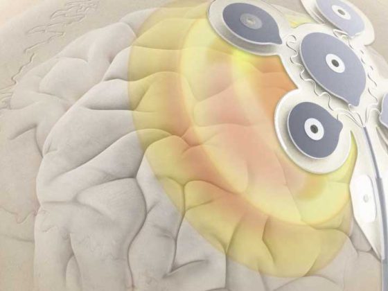 mm_percisis_stimulation