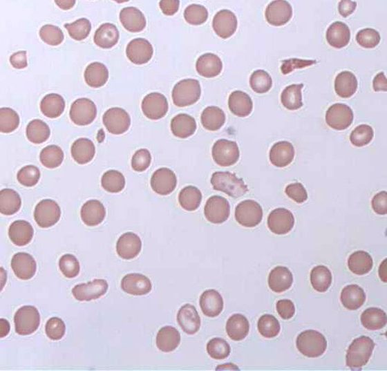 blutarmut_haemolytic_anaemia