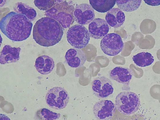 chronic_myeloid_leukemia_smear_2009-04-09
