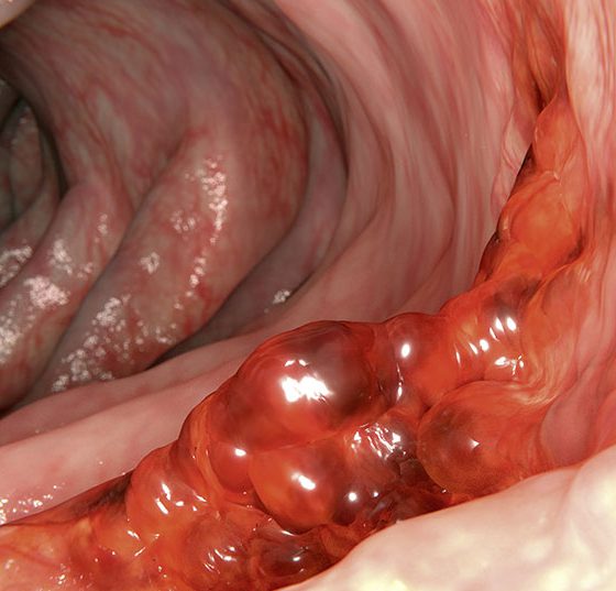 darmkrebs_istock-646161486