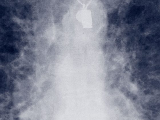 lungenfibrose_ipf_amiodarone