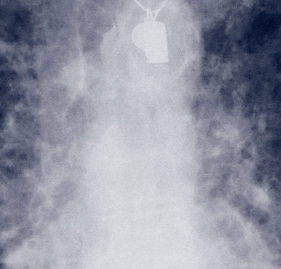 lungenfibrose_ipf_amiodarone