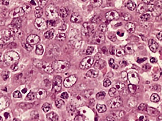 lymphoepithelioma_met_to_ln_6