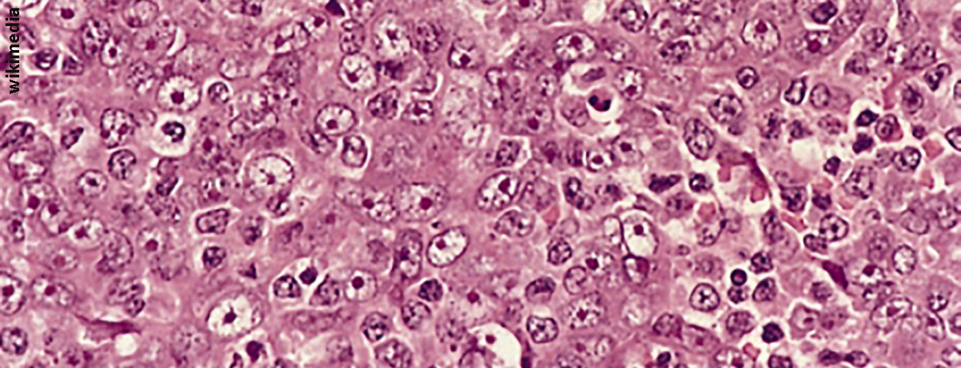 lymphoepithelioma_met_to_ln_6