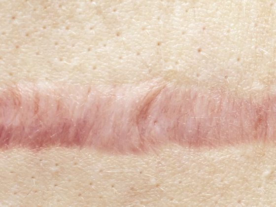 narbe_istock-1142492665