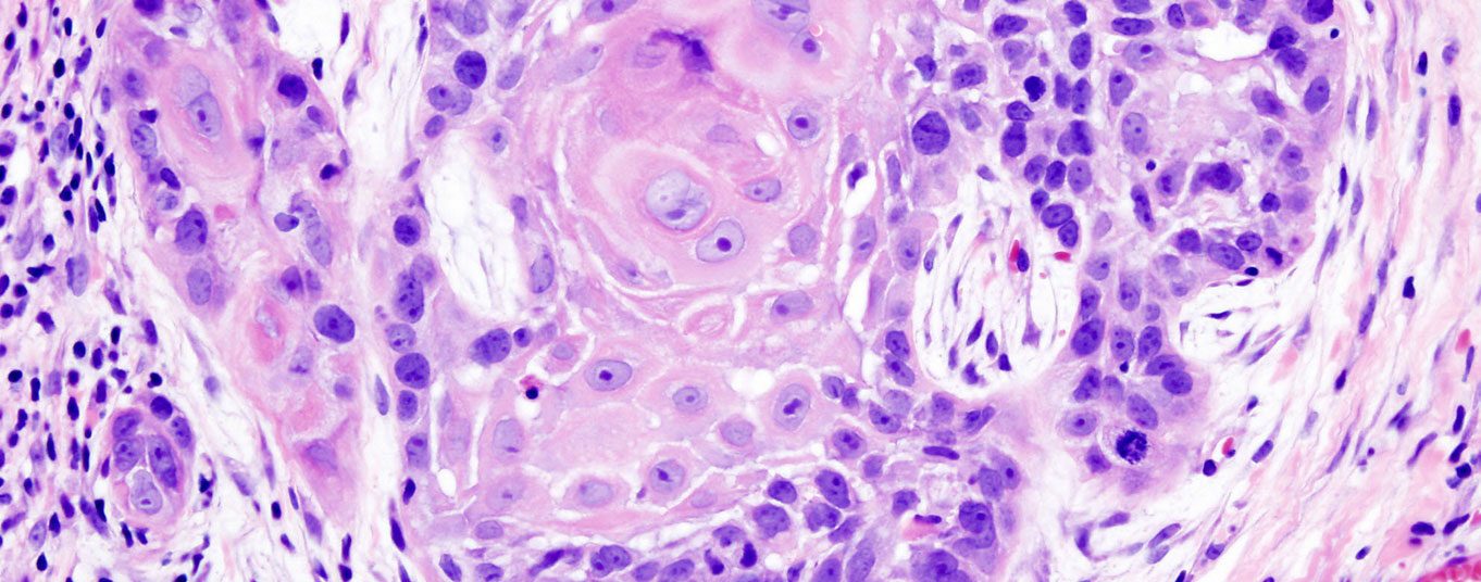 plattenepitelkarzinom_wikimedia