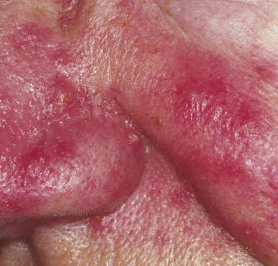 rosacea_wikimedia