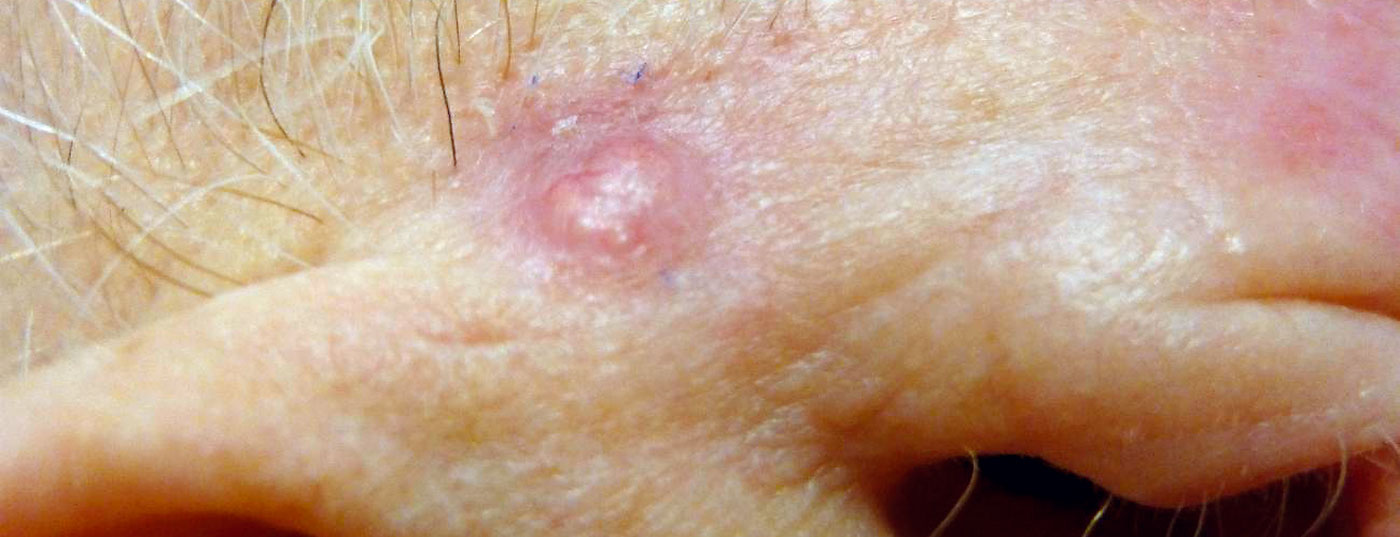 basalzellkarzinom_weisserhautkrebs