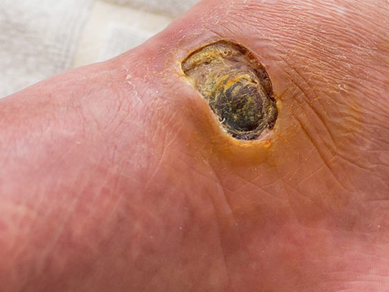 diabetes_fuss_istock-840170500