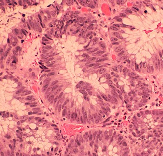 dickdarm_istock_000029832814_large