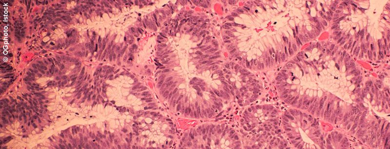 dickdarm_istock_000029832814_large