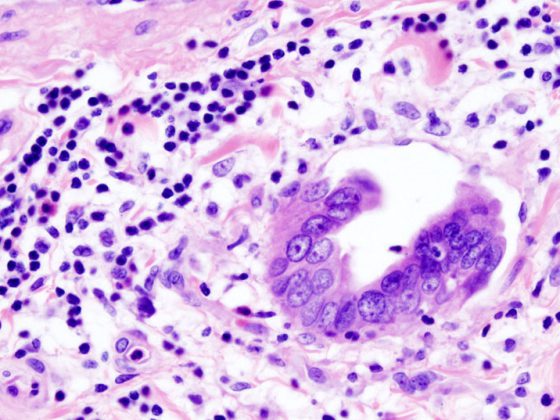 gallenblasenkarzinom