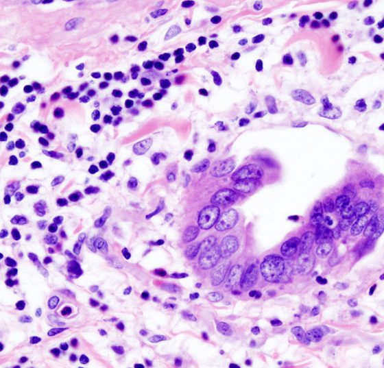 gallenblasenkarzinom