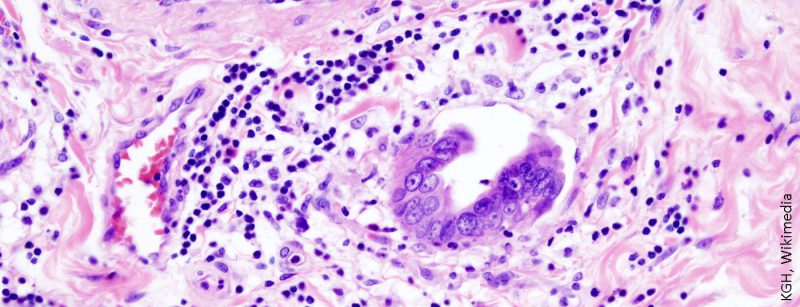 gallenblasenkarzinom