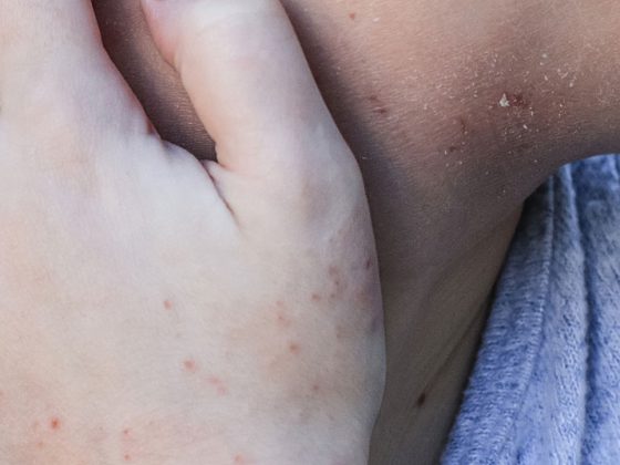 haut_ekzem_istock-1146529588