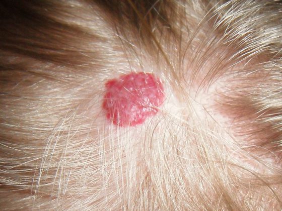 hemangioma