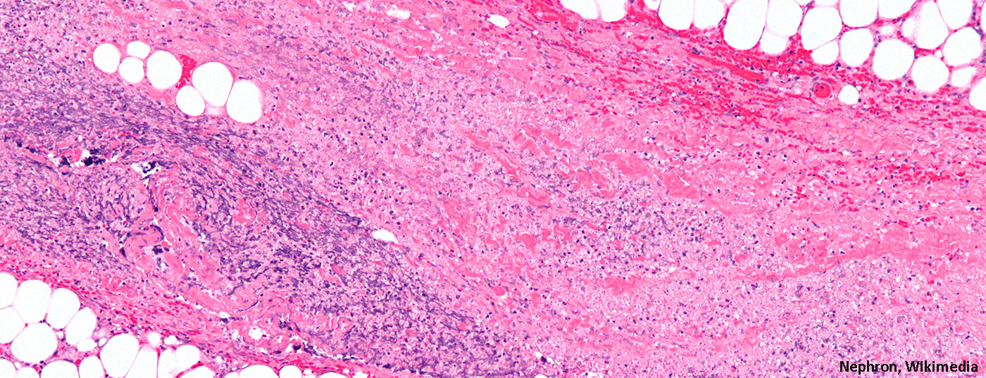 necrotizing_fasciitis_-_intermed_mag