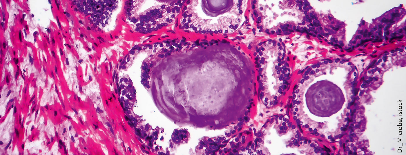 prostatahyperplasie_istock-1172925993