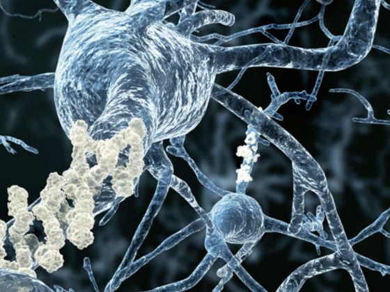 alzheimer_istock-151645089