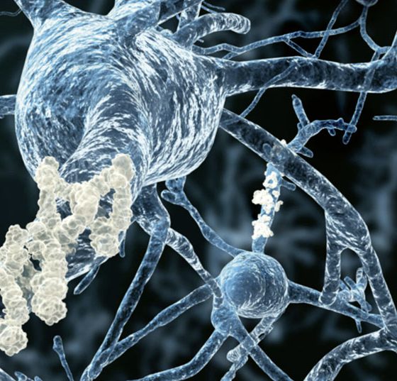 alzheimer_istock-151645089