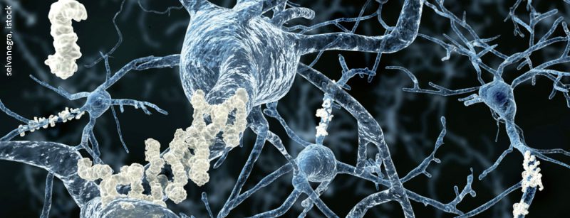 alzheimer_istock-151645089