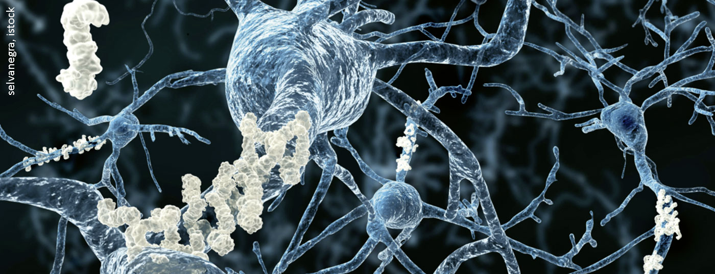 alzheimer_istock-151645089