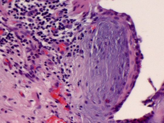 lungenfibrose_pneumo