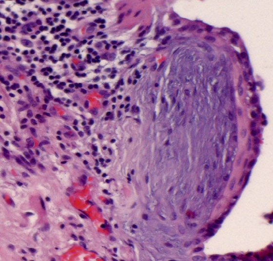 lungenfibrose_pneumo