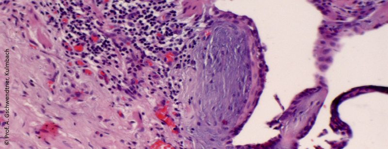 lungenfibrose_pneumo