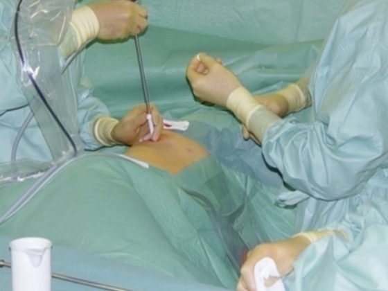 thorakoskopie_pneumo