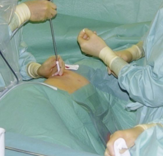 thorakoskopie_pneumo