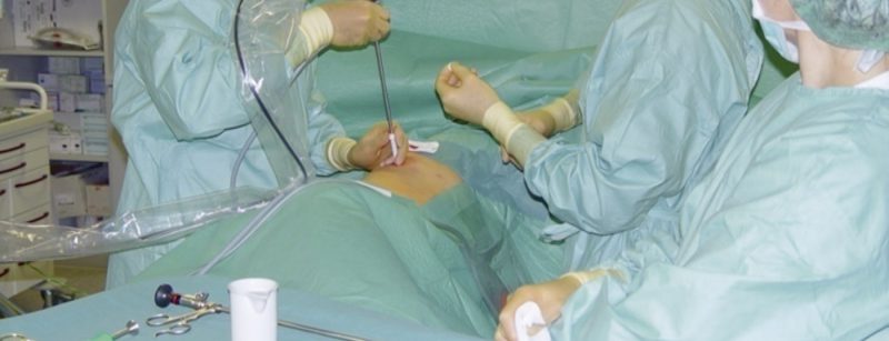 thorakoskopie_pneumo