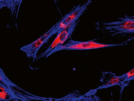 melanomzellen_istock-697088710