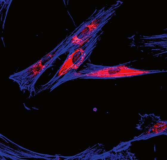 melanomzellen_istock-697088710