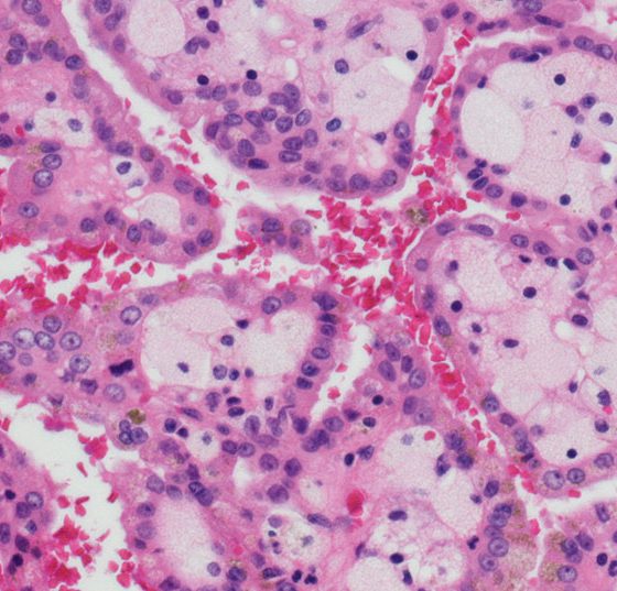 nierenzellkarzinom_istock-618736100