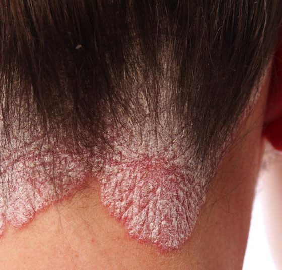 schuppenflechte_psoriasis