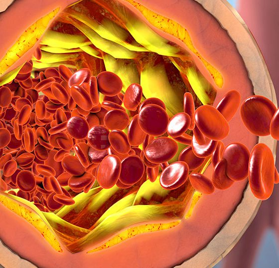 ader_atherosklerose_istock-875052952