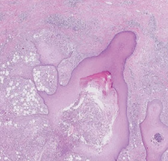 hidradenitis_suppurativa