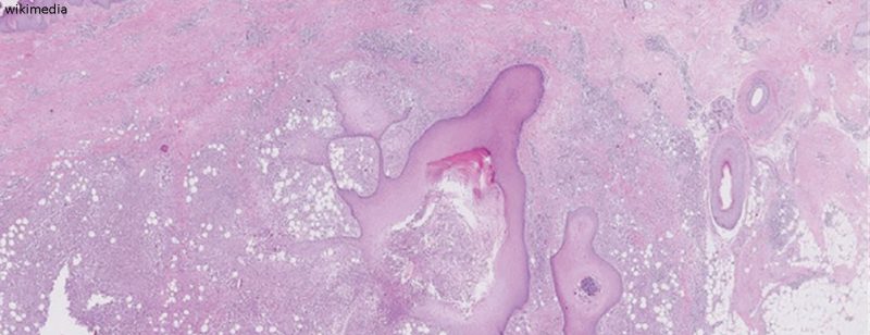 hidradenitis_suppurativa