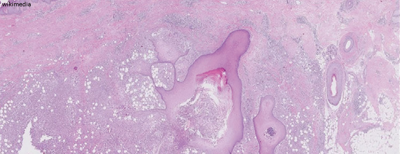 hidradenitis_suppurativa