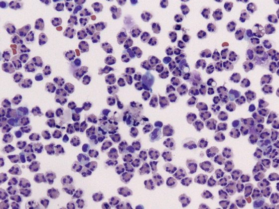 meningitis_bakteriell